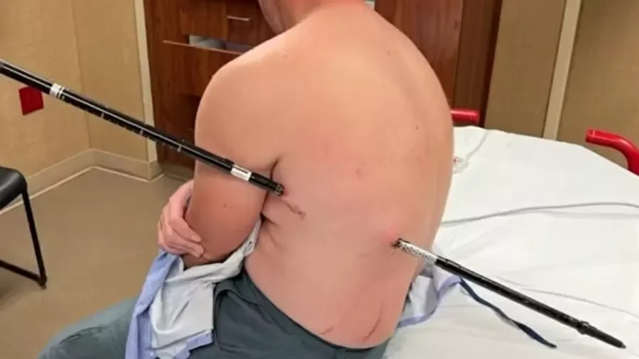 Enfermeiro anda 16 km com uma vara atravessada no corpo após acidente em montanha nos EUA
