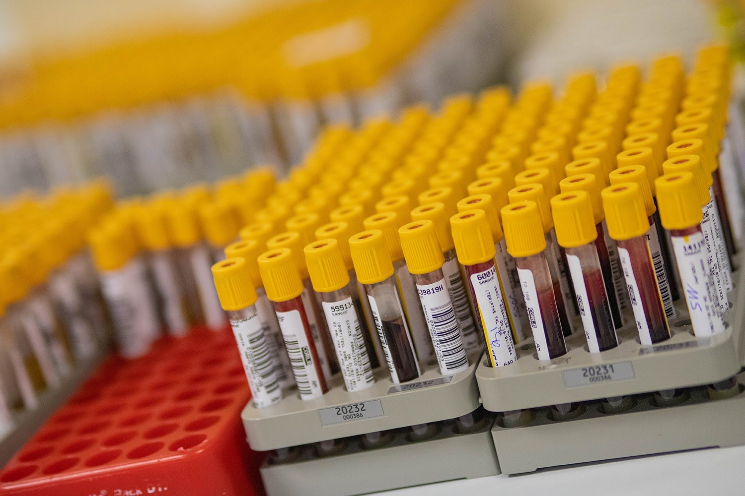 Exame de sangue poderá antecipar o risco de hipertensão pulmonar