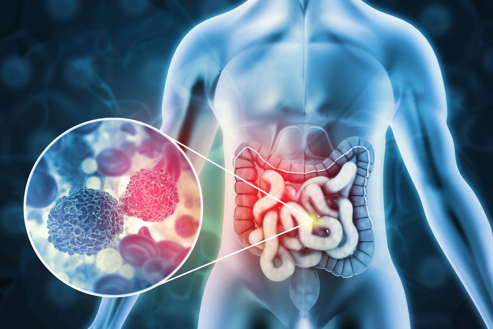 Do câncer de mama ao de intestino: diagnóstico tardio ainda é um dos principais desafios no Brasil