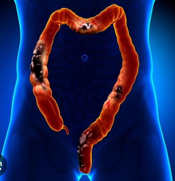 SUS terá novo exame para rastrear câncer de intestino no Brasil