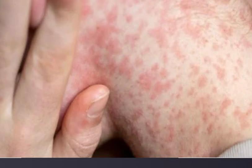 Após três casos de sarampo, FVS-AM emite alerta epidemiológico no Amazonas