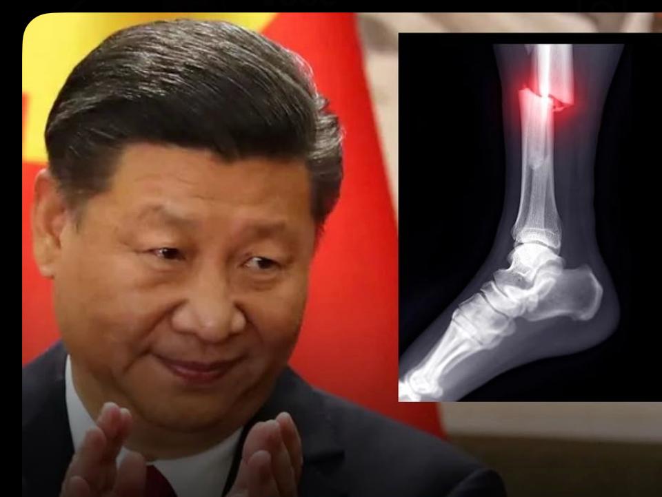 Cola óssea desenvolvida na China pode revolucionar tratamento de fraturas; recuperação pode começar em minutos