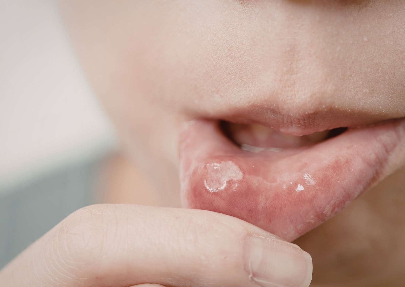 Carnaval exige atenção redobrada com a saúde bucal, alerta especialista